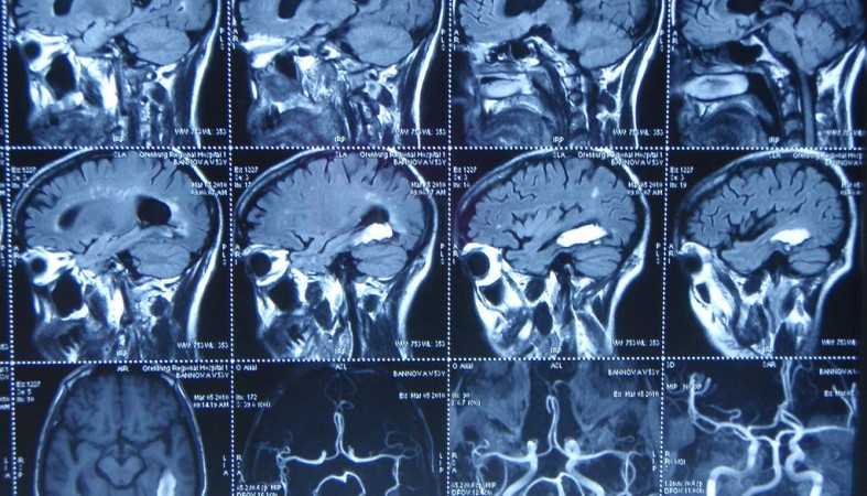 Мрт головного мозга: что показывает, подготовка, как проходит процедура, с контрастом, расшифровка - сделать мрт головного мозга в центре «мы и дети»