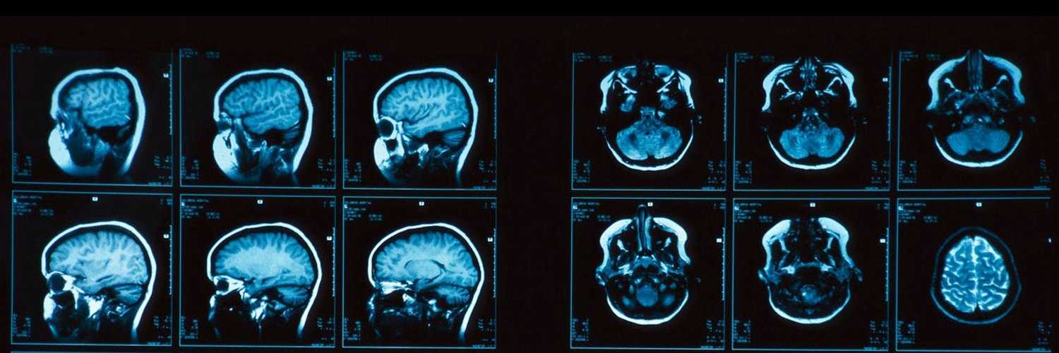 Мрт сосудов головного мозга (мрт-ангиография)