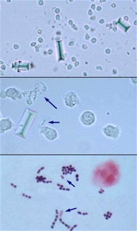 Бактерии и белки в моче. Струвиты микроскопия. Бактерии в моче микроскопия. Микроскопия мочи палочки. Кокки в моче микроскопия.