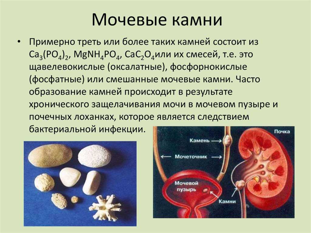 Мочекаменная болезнь. Мочекаменная болезнь камни в мочевом пузыре. Заболевания мочевыделительной системы мочекаменная болезнь. Почечнокаменная болезнь механизмы образования почечных камней. Конкременты при мочекаменной болезни.